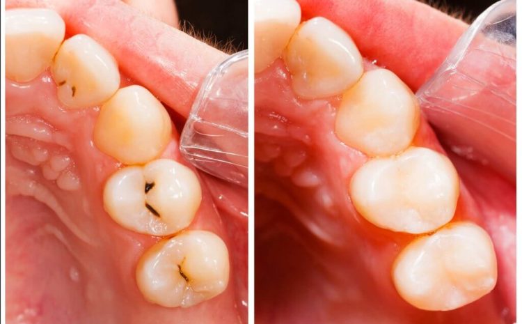 پوسیدگی دندان چیست ؟